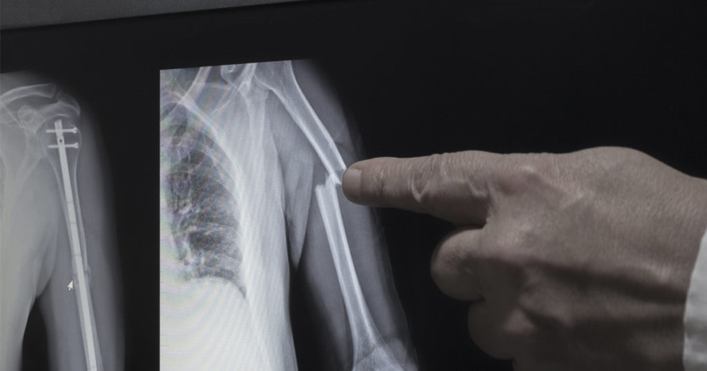 broken bone